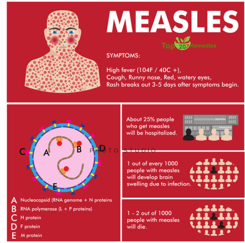 How to prevent measles naturally