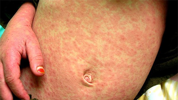 Progress Toward Measles Elimination â European Region ...