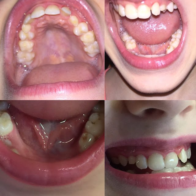 The REAL Deal: 5 cavities HEALED in Autistic Child